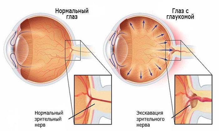 Как лечить глаукому народными средствами - "здоровое око"