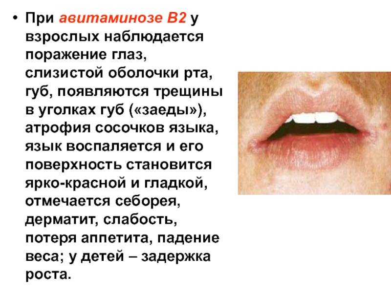 Почему сохнут губы у женщин и мужчин: причины, лечение в домашних условиях