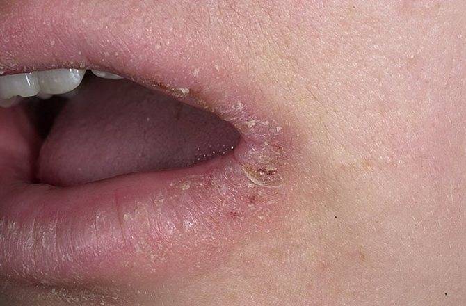 Трещина в уголке рта причины лечение у ребенка