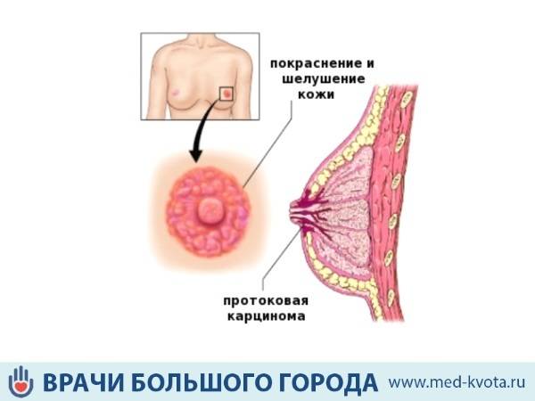 Выделения из грудных желез при надавливании - 7 причин, виды, диагностика, лечение