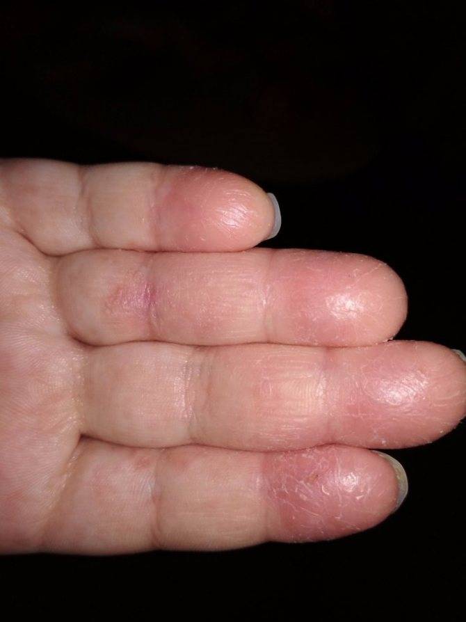 Облазит кожа на пальцах рук: фото, причины, лечение | заболевания кожи