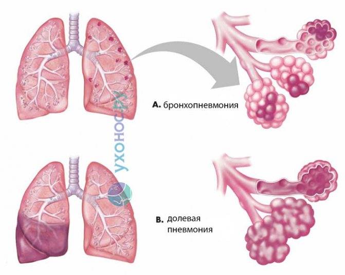 Двухсторонняя пневмония у детей