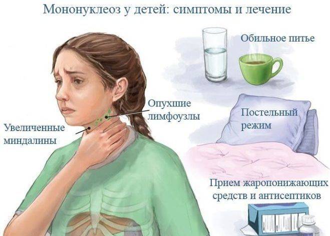 Симптомы и лечение инфекционного мононуклеоза.