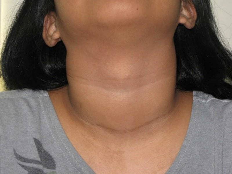 Признаки нарушения щитовидной железы у женщин могут быть схожи с другими заболеваниями