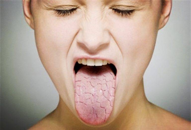 Почему сушит во рту: причины и симптомы