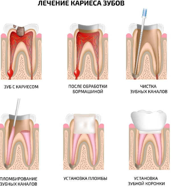 Кариес корня зуба: лечение, симптомы, стадии и профилактика