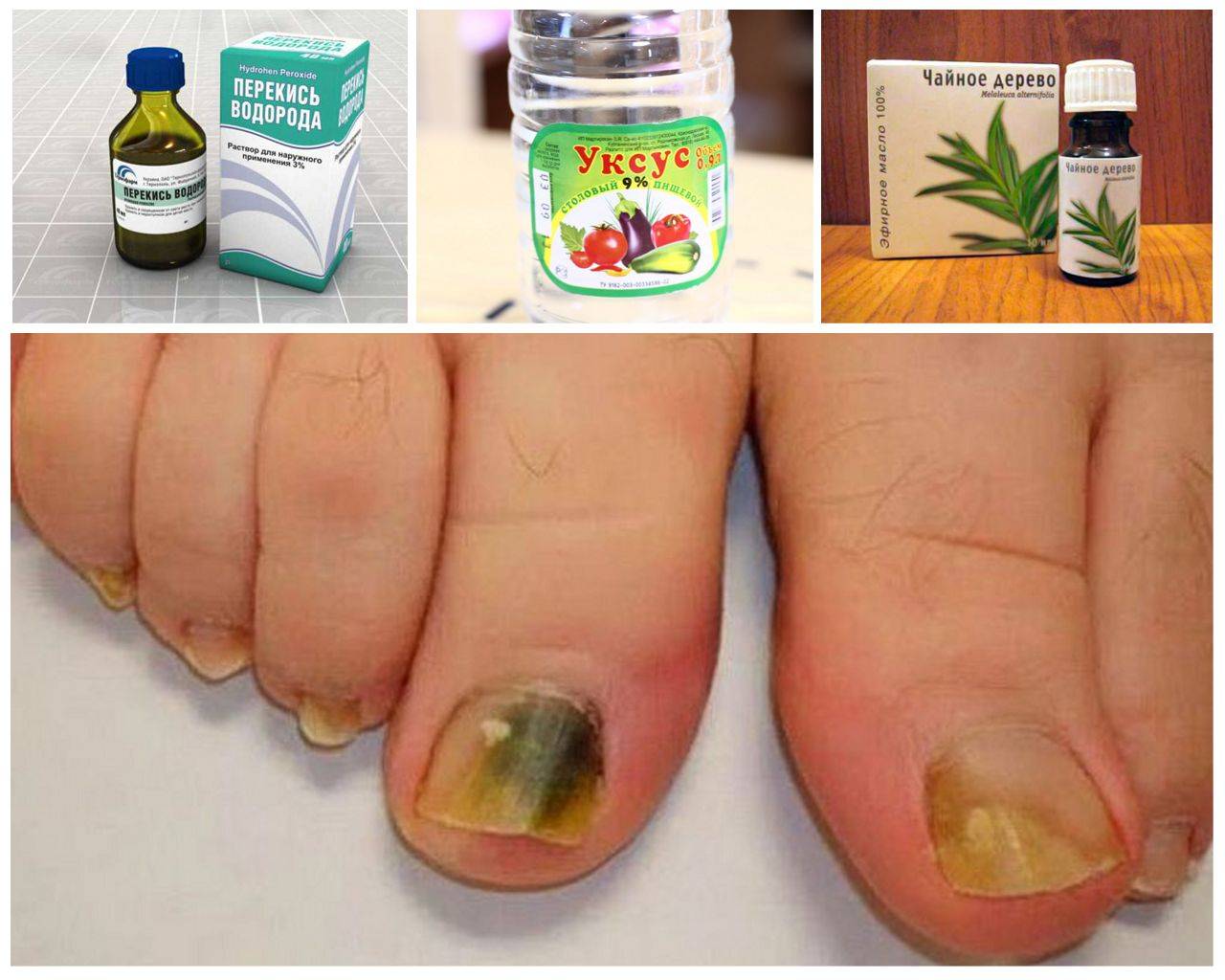 Лечение грибка ногтей народными средствами в домашних условиях