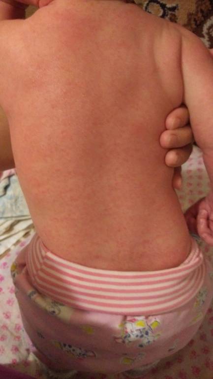 Пищевая аллергия сыпь на теле | неталлергии!