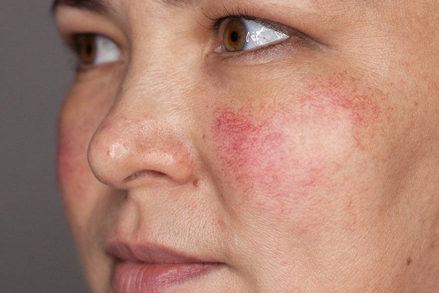 Купероз на лице: фото, причины и лечение в домашних условиях