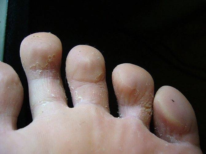 Как самостоятельно вылечить грибок между пальцами ног