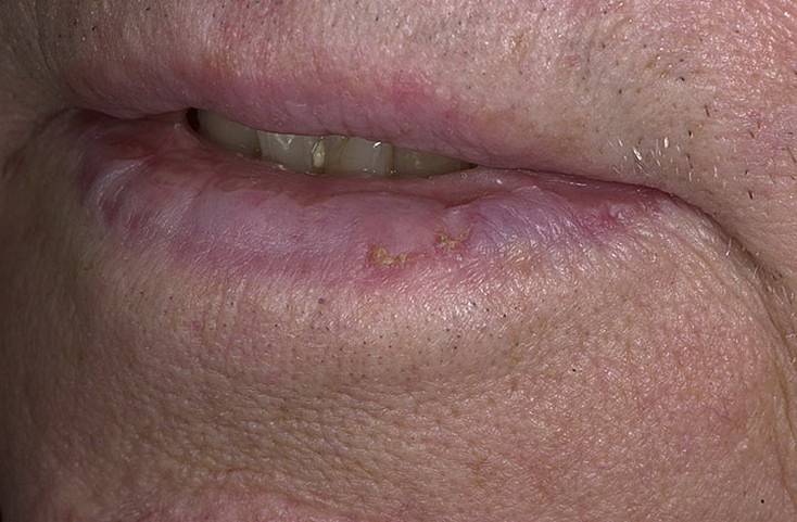 Признак сниженного иммунитета – болячки в уголках губ у ребенка