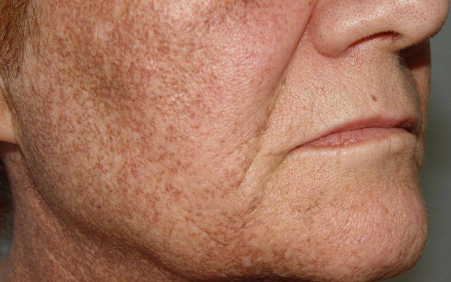 Пигментные пятна на лице: причины и лечение в домашних условиях
