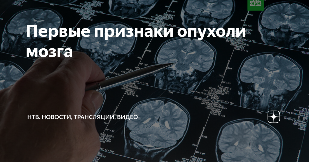 Симптомы онкологии головного мозга