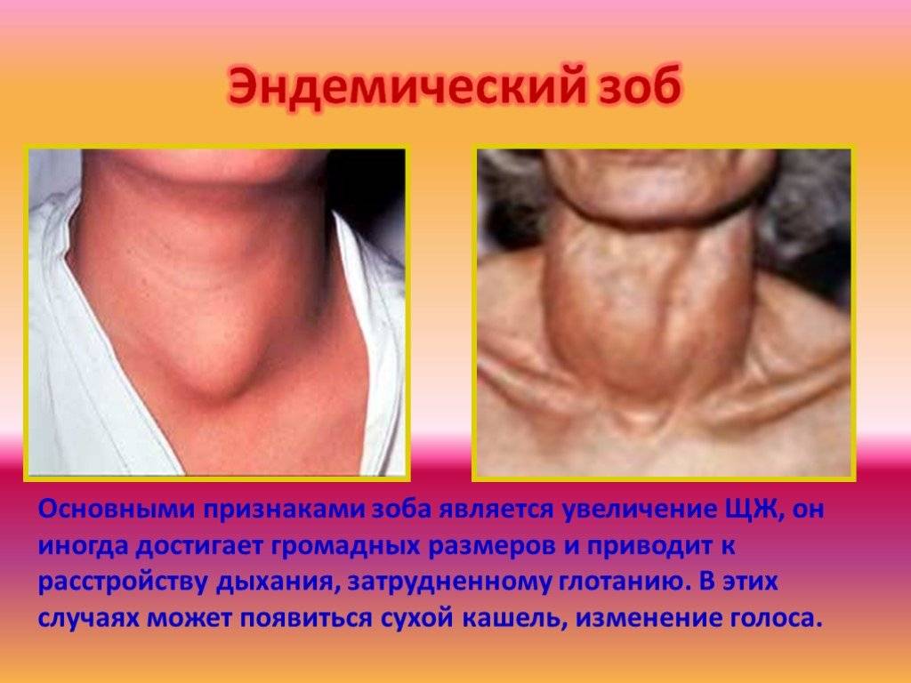 Первые симптомы проблем с щитовидной железой, которые не стоит игнорировать