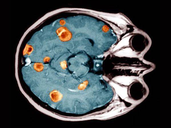 Метастазы в головной мозг при раке легких: сколько живут, симптомы и лечение