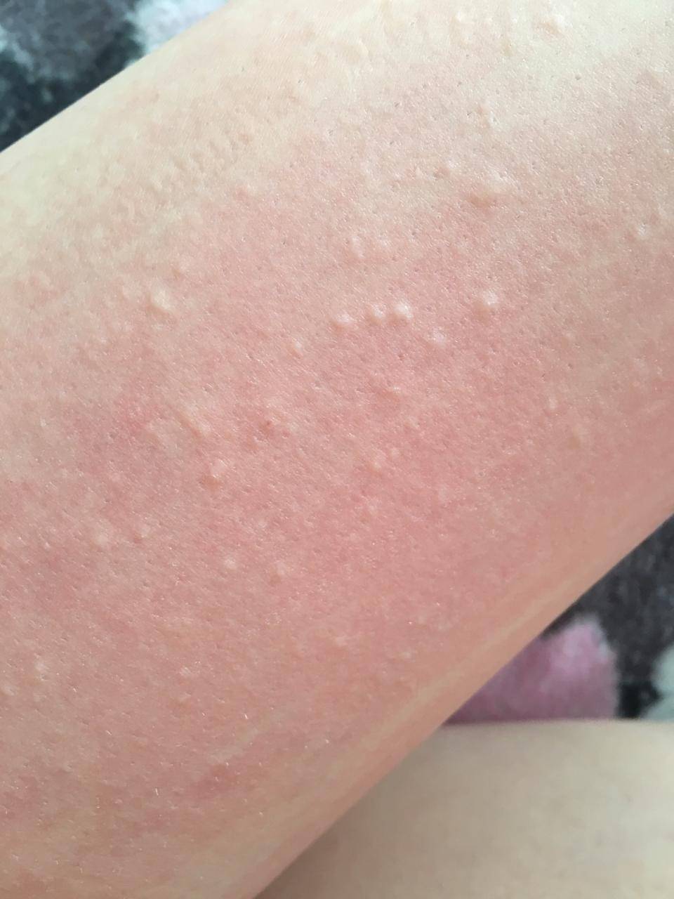 Как выглядит сыпь при аллергии?