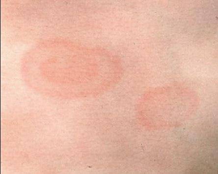 Почему появляются красные круглые пятна на коже обзор заболеваний и методов лечения