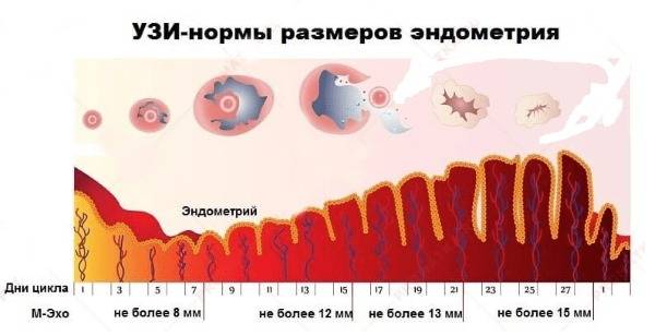 Серозометра матки в менопаузе: лечение скопления жидкости в полости матки, причины патологии у женщин, прогнозы врачей
