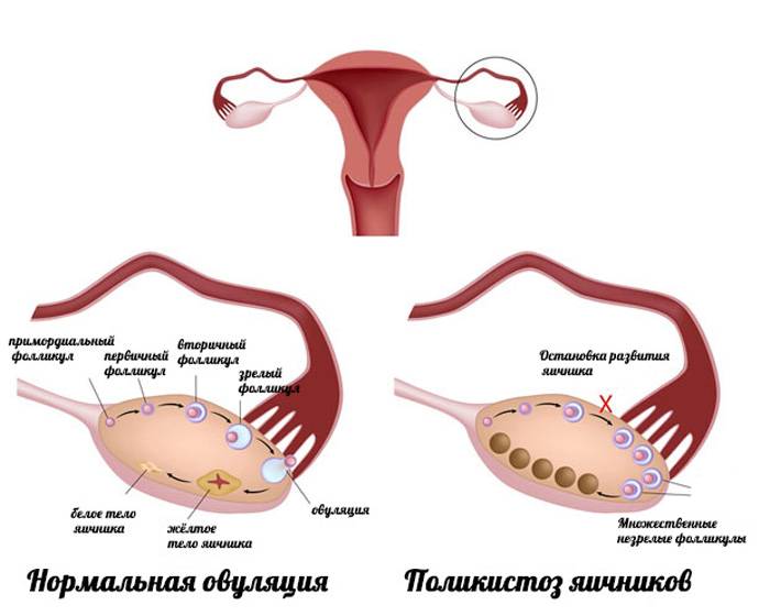 Норма количества фолликулов в яичниках при менопаузе