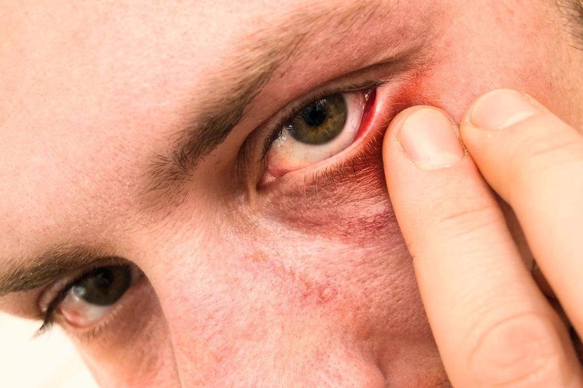 Аллергия под глазами: причины и лечение, мази, фото
