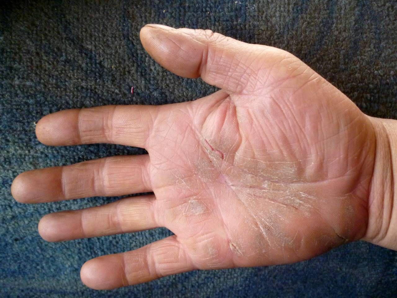 Почему шелушится кожа на пальцах рук, что нужно делать? методы лечения