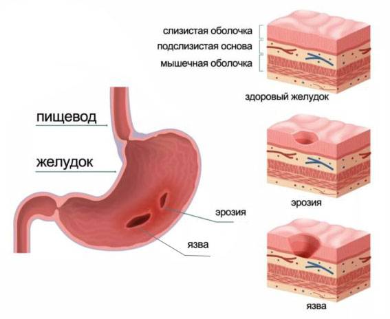 Гастрит кардиомагнил | все вопросы и ответы о "гастрит кардиомагнил" | 03.ru - скорая помощь онлайн