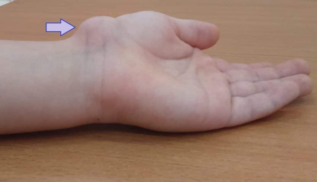 Шишка на запястье руки - гигрома запястья: симптомы, причины, лечение шишки на руке