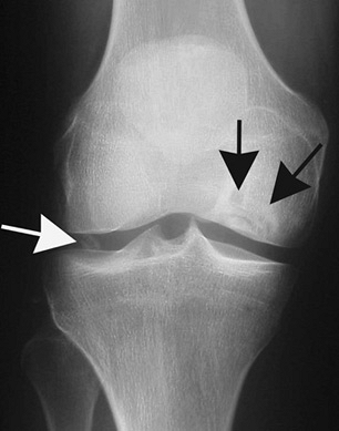 Болезнь кенига коленного сустава. что это такое, взрослых, лечение, операция, спортсменов, стадии у детей - все о суставах