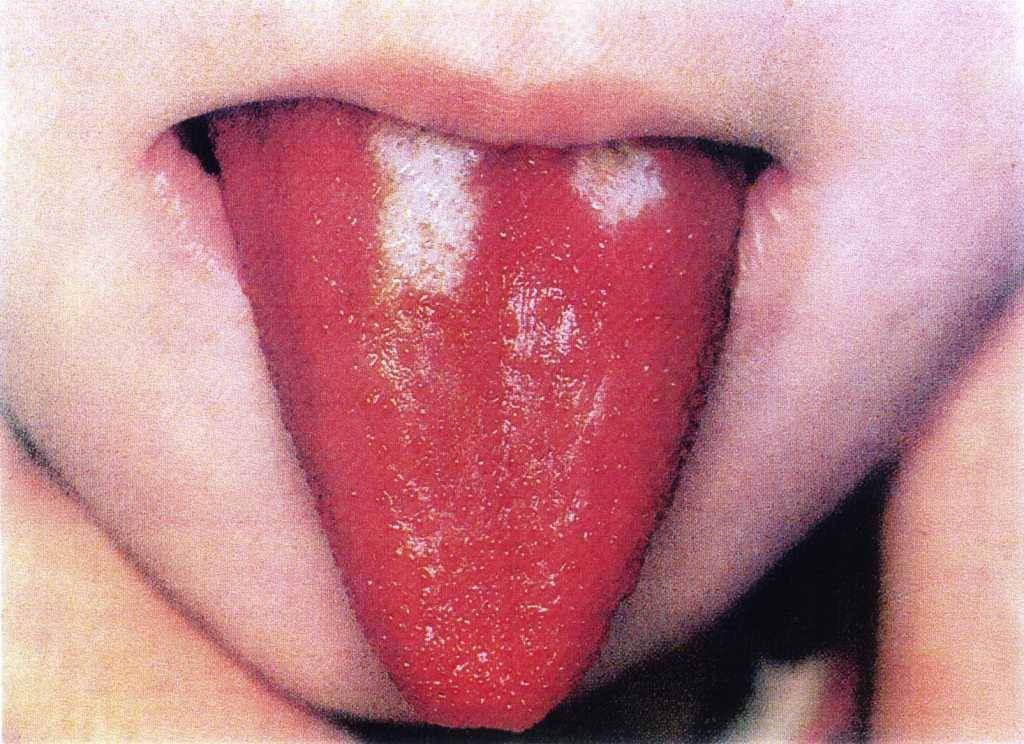 Кончик языка красный и щиплет – как справиться с симптомом?