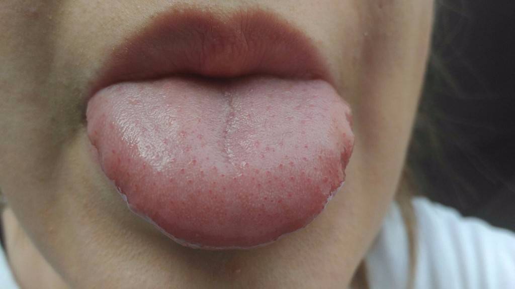 Один из симптомов и неприятных последствий гастрита сухость во рту