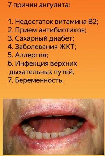 Трещины на губах (в уголках рта): какого витамина не хватает?