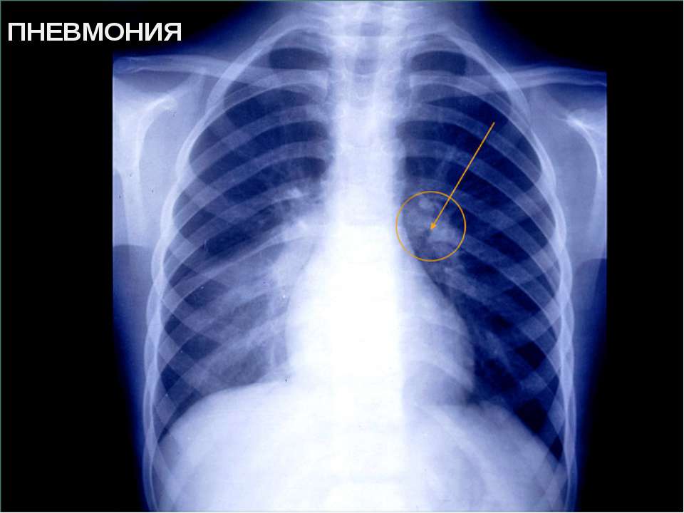 Двухсторонняя пневмония: причины, симптомы, лечение, последствия, смертность