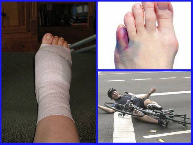 Перелом пальца на ноге (мизинца, большого): что делать, как быстро вылечить, симптомы