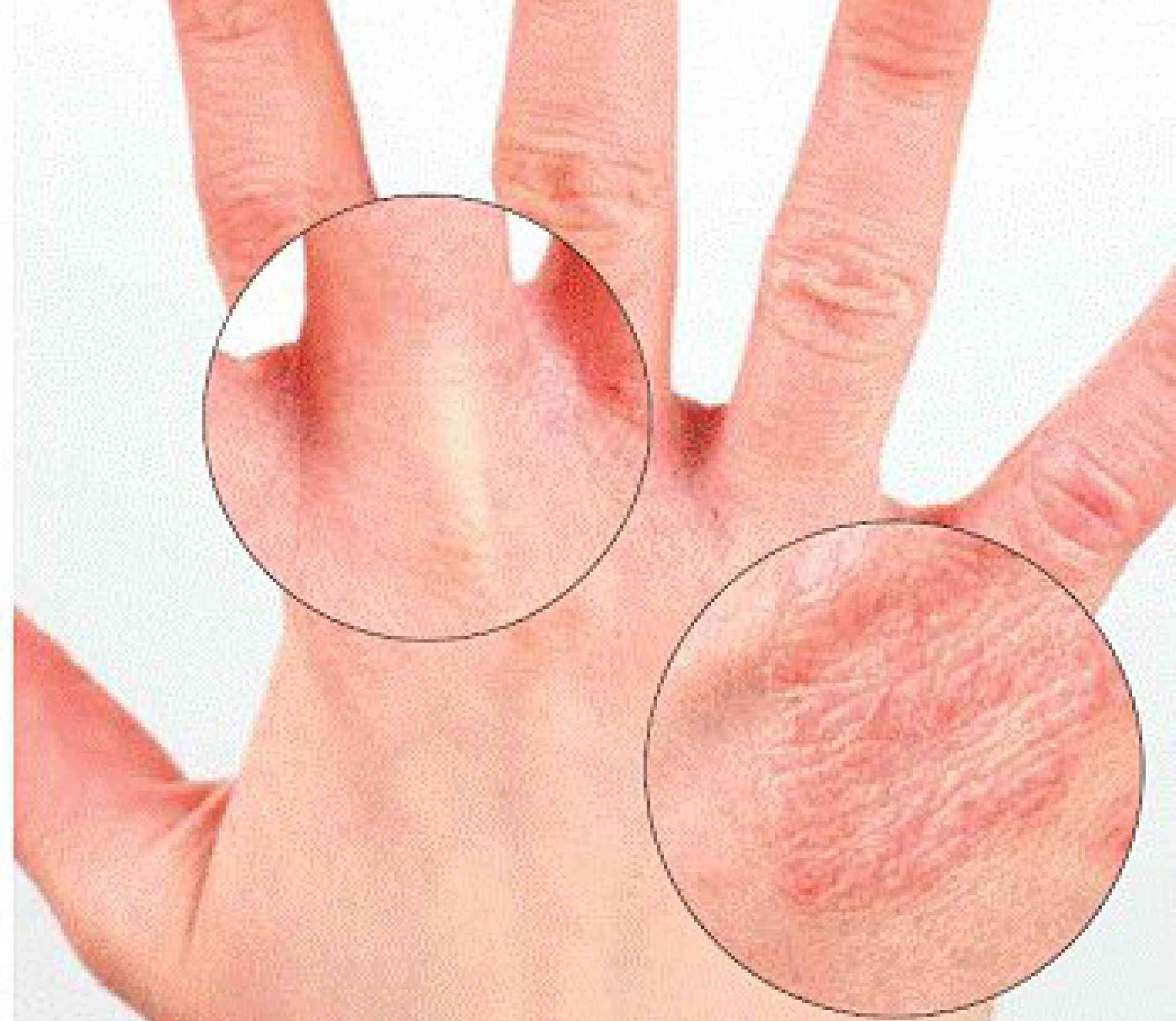 Дисгидротическая экзема кистей рук: причины и симптомы, лечение мазями и народными средствами