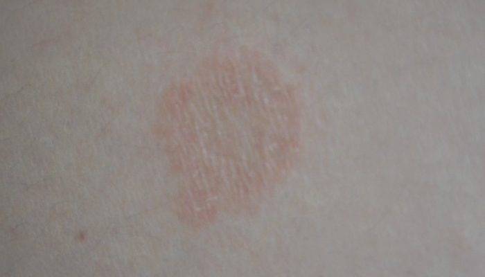 Красное пятно на коже чешется и шелушится: причины, лечение