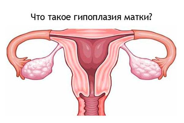 Гипоплазия матки: что это и можно ли забеременеть с такой патологией? * клиника диана в санкт-петербурге
