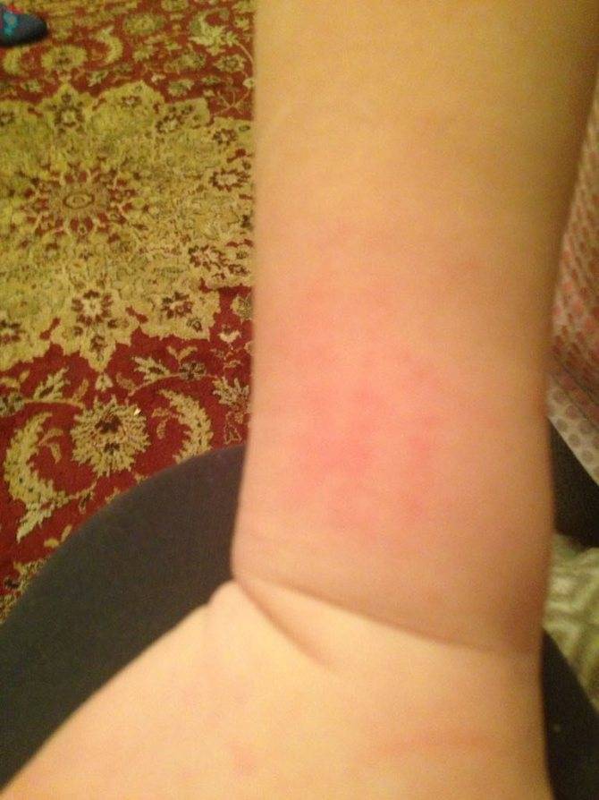 Виды аллергической сыпи (пятен) на коже - как выглядит, чем лечить ( фото)