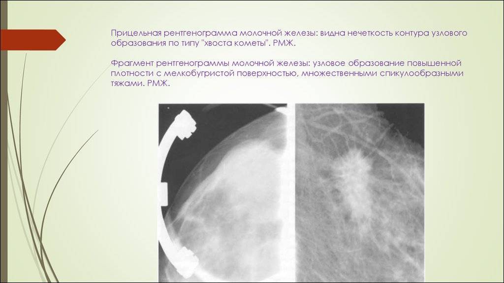 Признаки фиброзных изменений молочных желез. Кистозная мастопатия маммография. Фиброаденома молочной железы маммография. Саркома молочной железы на рентгенограмме. Узловая мастопатия на маммографии.