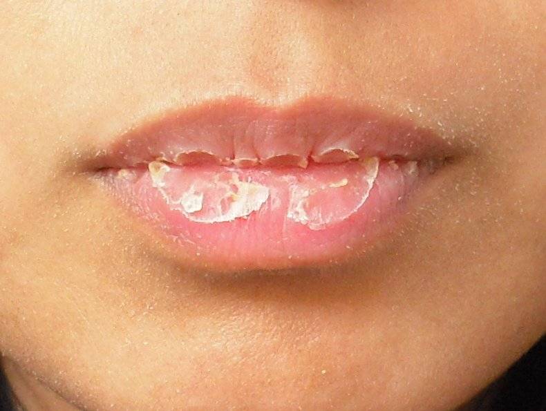 Шелушатся губы: причины, дополнительные симптомы, лечение, профилактика