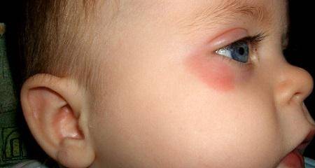 Красные глаза при простуде и орви: причины у взрослого, сочетание покраснения, слезливости и насморка