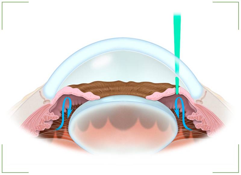 Иридэктомия: лазерная операция при глаукоме и восстановление в послеоперационный период