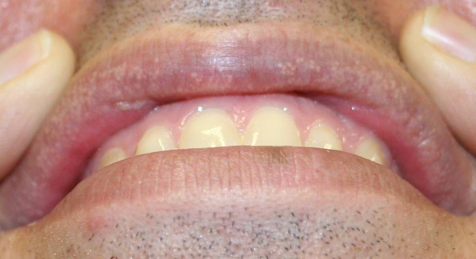 Sabor metalico en la boca cetosis