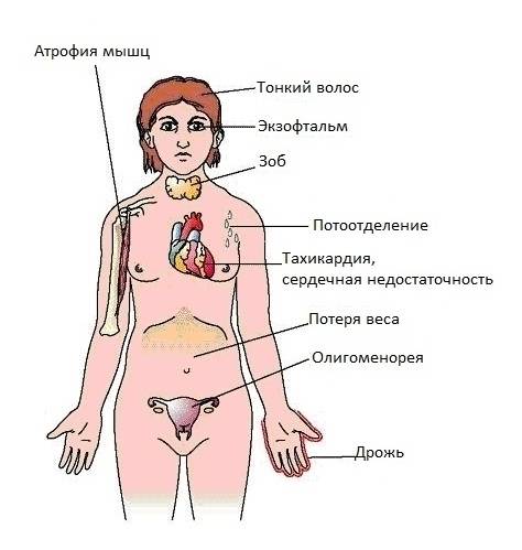 Тиреотоксикоз щитовидной железы: симптомы у женщин и мужчин