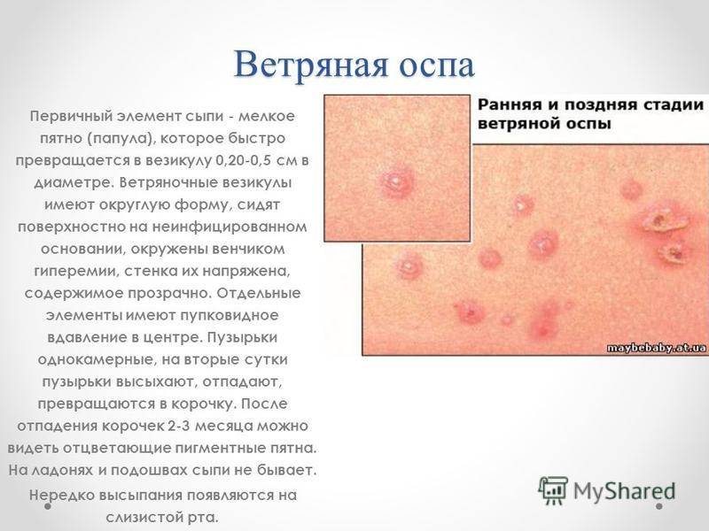 Ветрянка у взрослых: как выглядит на фото, как начинается, симптомы и лечение, прививки | pro-herpes.ru