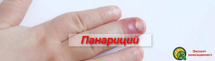 Панариций пальца на руке и ноге: лечение, препараты, народные методы