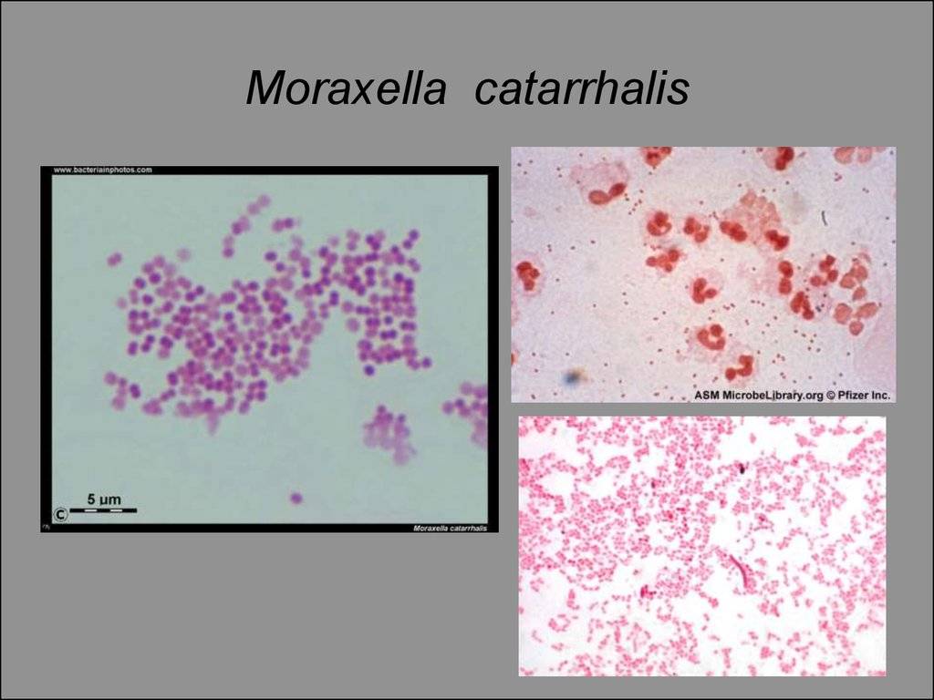 Инфекции, вызываемые moraxella catarrhalis (моракселла катаралис): схема лечения
