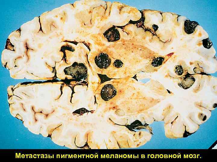 Метастазы в головном мозге: симптомы, причины появления и продолжительность жизни