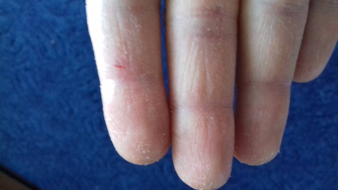 Шелушится кожа между пальцами рук: фото, возможные болезни, лечение