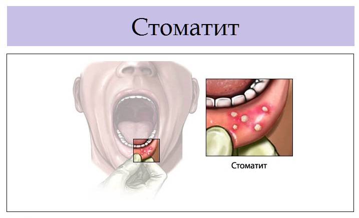 Стоматит у детей: симптомы и лечение, фото начальная стадия
