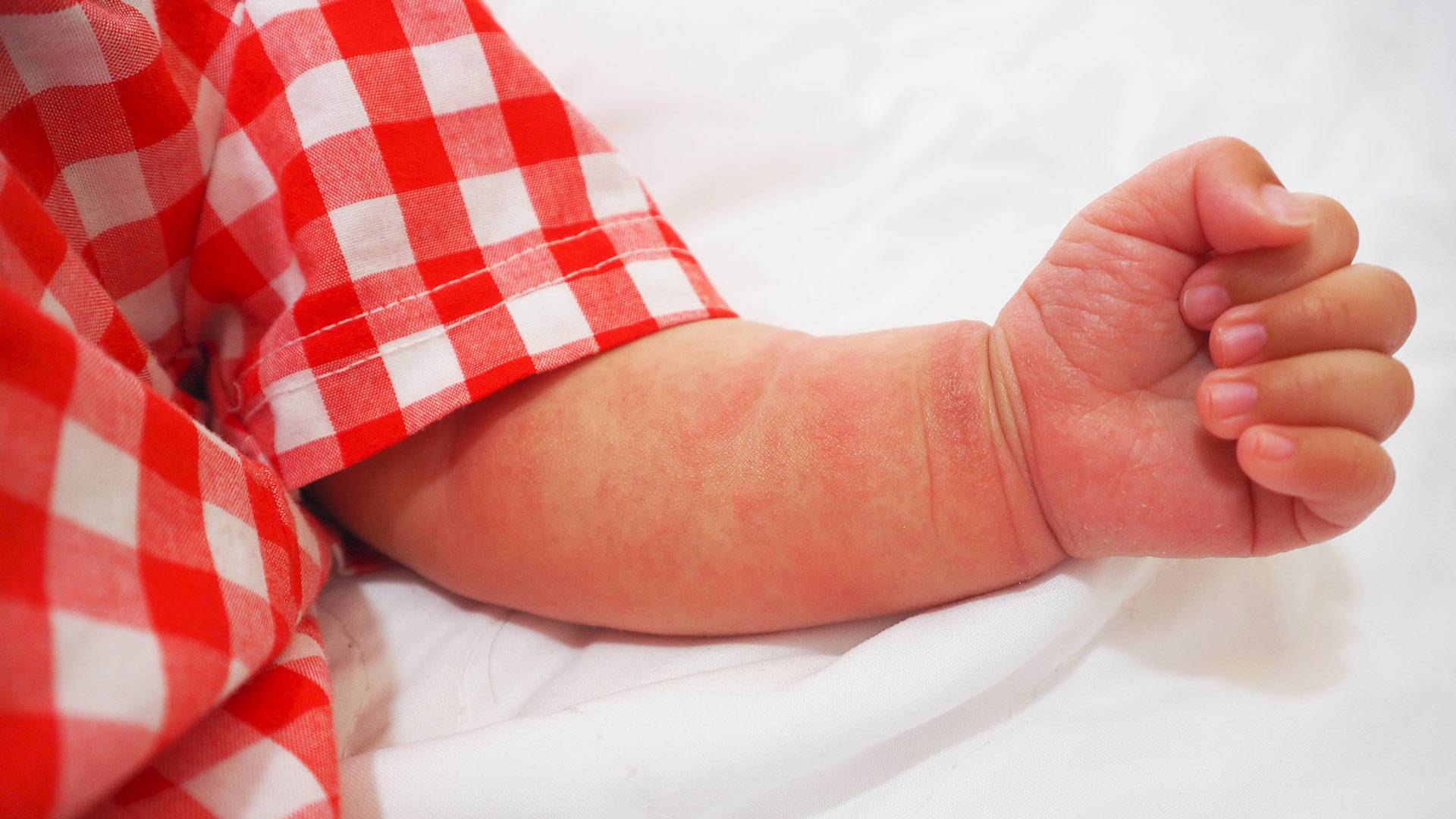Атопический дерматит на ногах у ребенка 1 год